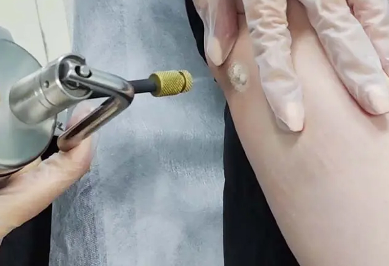 کاربرد نیتروژن مایع در دستگاه‌های جراحی